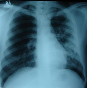 Left mid zone Koch's infection 5