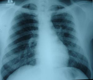 Left mid zone Koch's infection 7