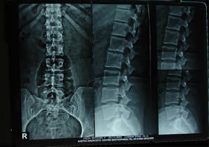 Lumbosacral spine 1