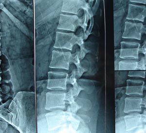 Lumbosacral spine 2