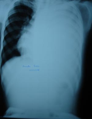 Massive pleural effusion