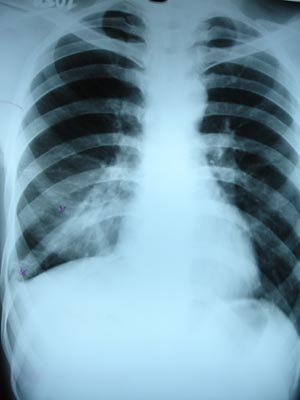 Minimal pleural effusion2