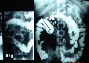 Normal barium follow through