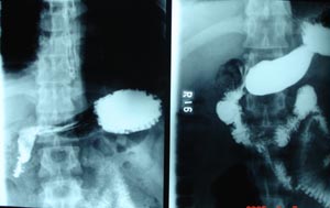 Normal barium swallow