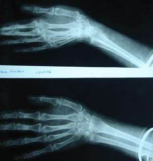 Normal upper extremity AP & lateral view