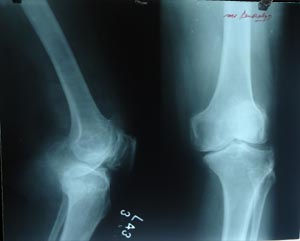 Osteoarthritis of knee