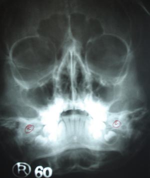 Paranasal air sinuses