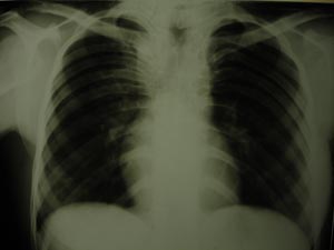 Paratracheal opacity