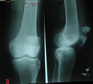 Patellar fracture