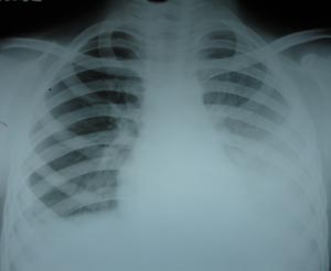 Pleural effusion
