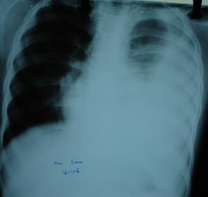 Pleural effusion3