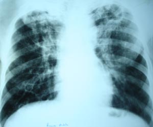 Pulmonary Koch's with cavitation