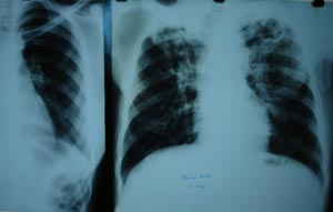Pulmonary tuberculosis 1