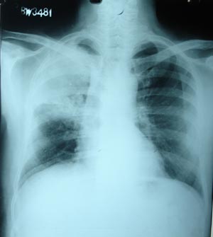 Pulmonary tuberculosis 2