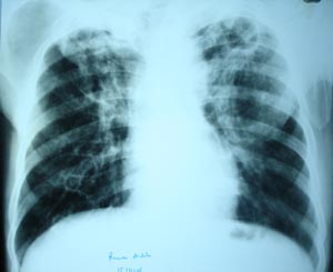 Pulmonary tuberculosis with cavitation