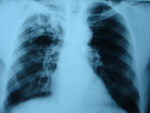 Pulmonary tuberculosis
