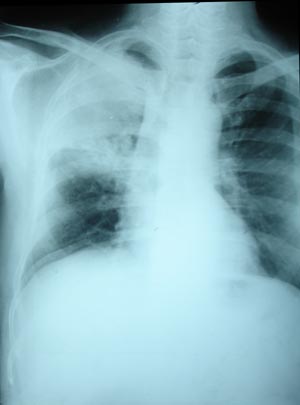 Right upper & mid zone TB infection