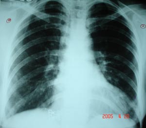 Resolving Pneumonia