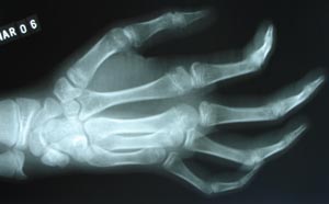 Rheumatoid Arthitis