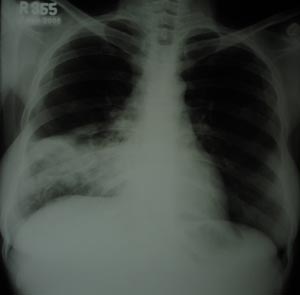 Right  lower zone opacity 3