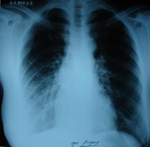 Right lower zone opacity