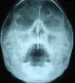 Right Maxillary Sinusitis 2