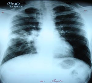 Right mid zone opacity 3