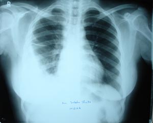 Right pleural effusion